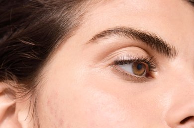 lieu-cac-san-pham-tu-sua-co-gay-mun-trung-ca