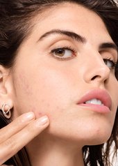 mụn-nội-tiết-tố-là-gì-và-thói-quen-chăm-sóc-da-hỗ-trợ-cải-thiện-như-thế-nào
